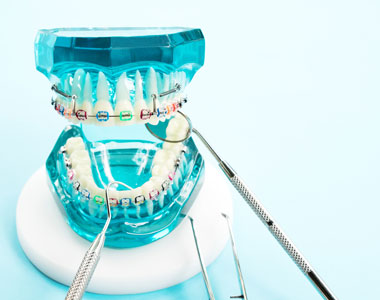 Braces- treatment at comfortsmiles in Ann Arbor  