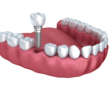 Will Dental Implants really help you? Let’s see what the Clinical results say?- treatment at comfortsmiles in Ann Arbor  