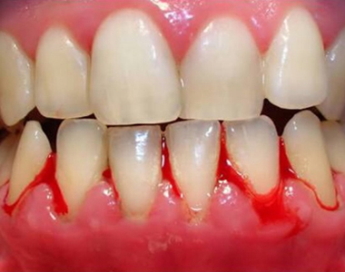 Five Preventive measures to stop Bleeding Gums- treatment at comfortsmiles in Ann Arbor  