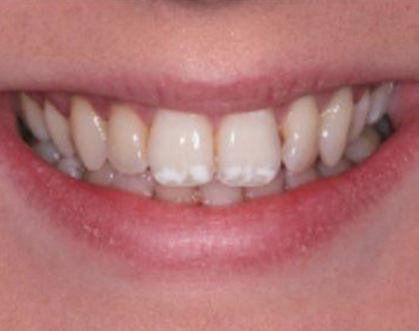 What You Need to Know About Fluorosis- treatment at comfortsmiles in Ann Arbor  
