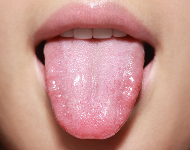 Will cleaning your tongue help reduce the risk of heart disease, arthritis, and other inflammatory diseases?- treatment at comfortsmiles in Ann Arbor  