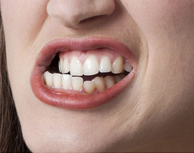 Teeth Grinding- treatment at comfortsmiles in Ann Arbor  