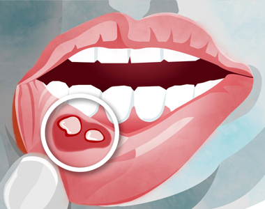How to Get Rid of Canker Sores Naturally- treatment at comfortsmiles in Ann Arbor  