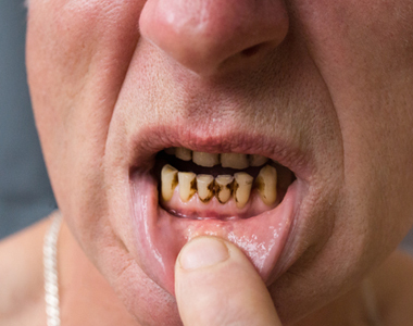 Meth Mouth: How Methamphetamine Use Affects Dental Health- treatment at comfortsmiles in Ann Arbor  
