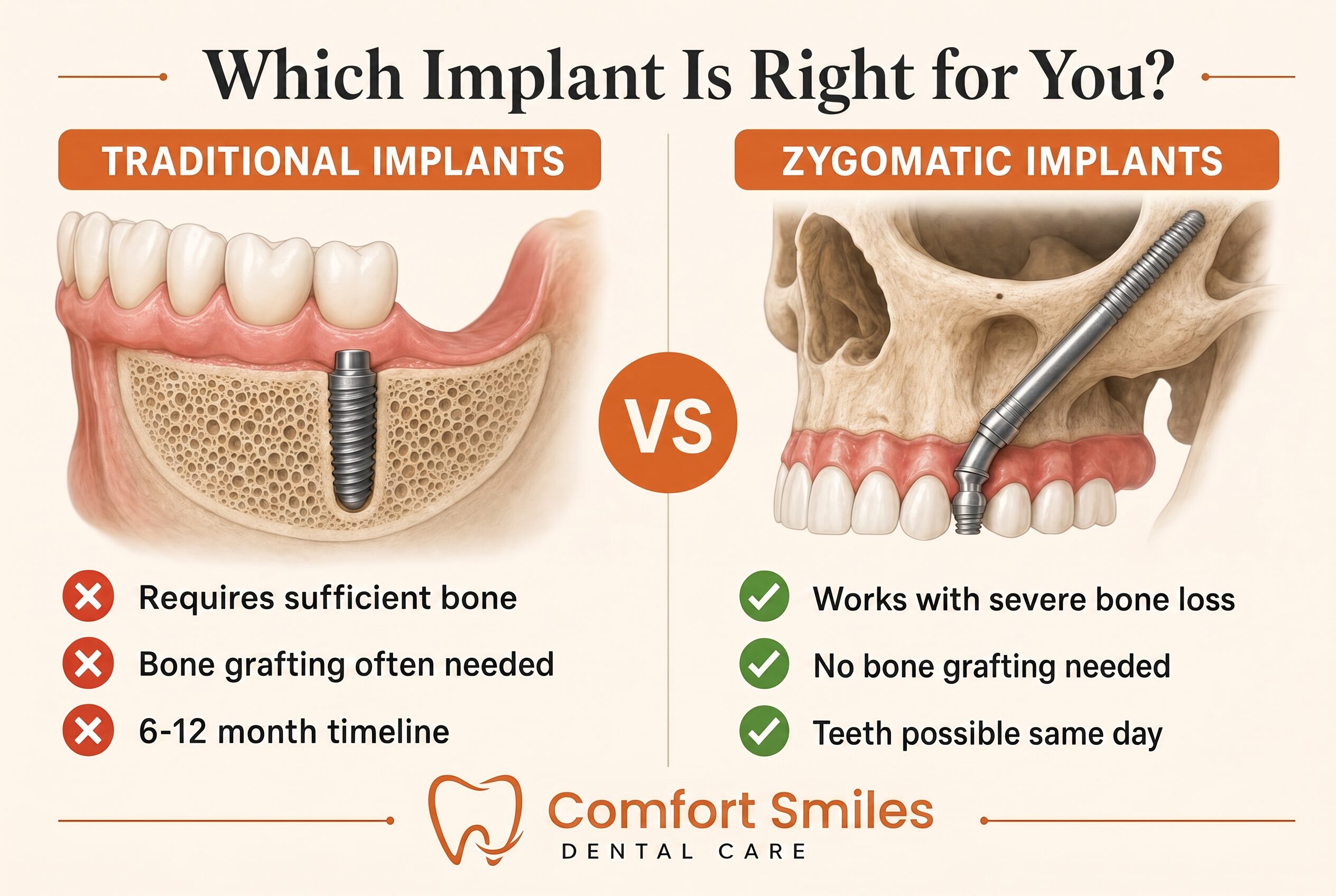 Infographic showing how zygomatic implants bypass jawbone loss