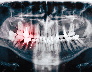 Dental x-ray- treatment at comfortsmiles in Ann Arbor  