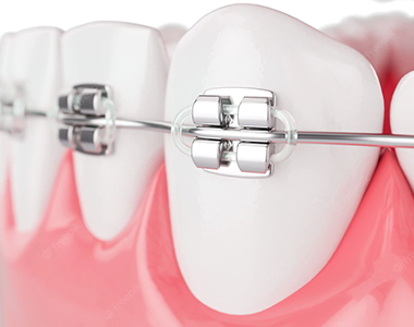 braces and orthodontic treatment
