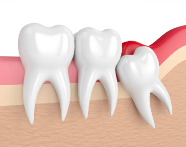 Wisdom Teeth- treatment at comfortsmiles in Ann Arbor  