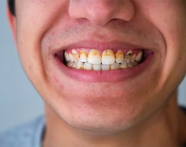 The Devastating Effects of Methamphetamine Use on Dental Health- treatment at comfortsmiles in Ann Arbor  