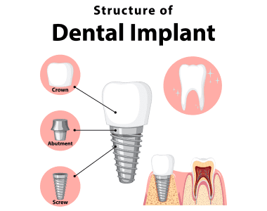 Dental Implants Ann Arbor MI