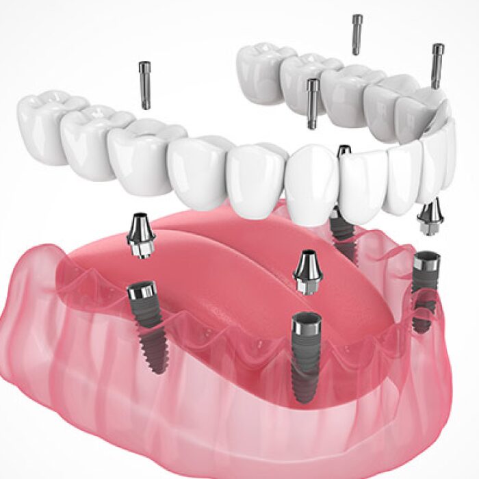 Implant-Supported Dentures-1
