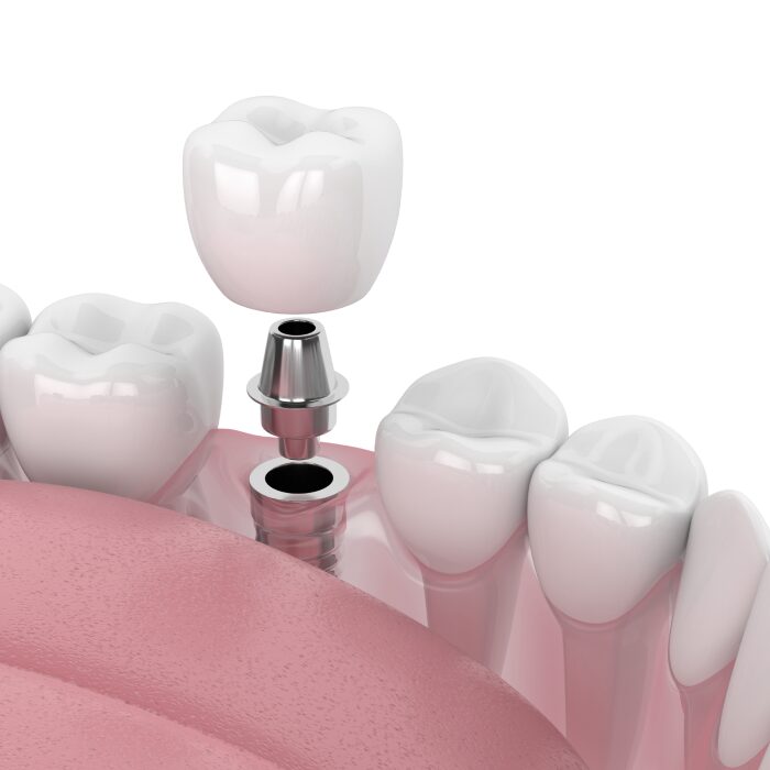 Single Dental Implants