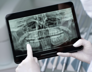 Dental X-Ray