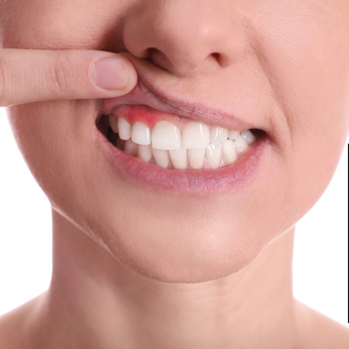 Periodontal (Gum) Therapy