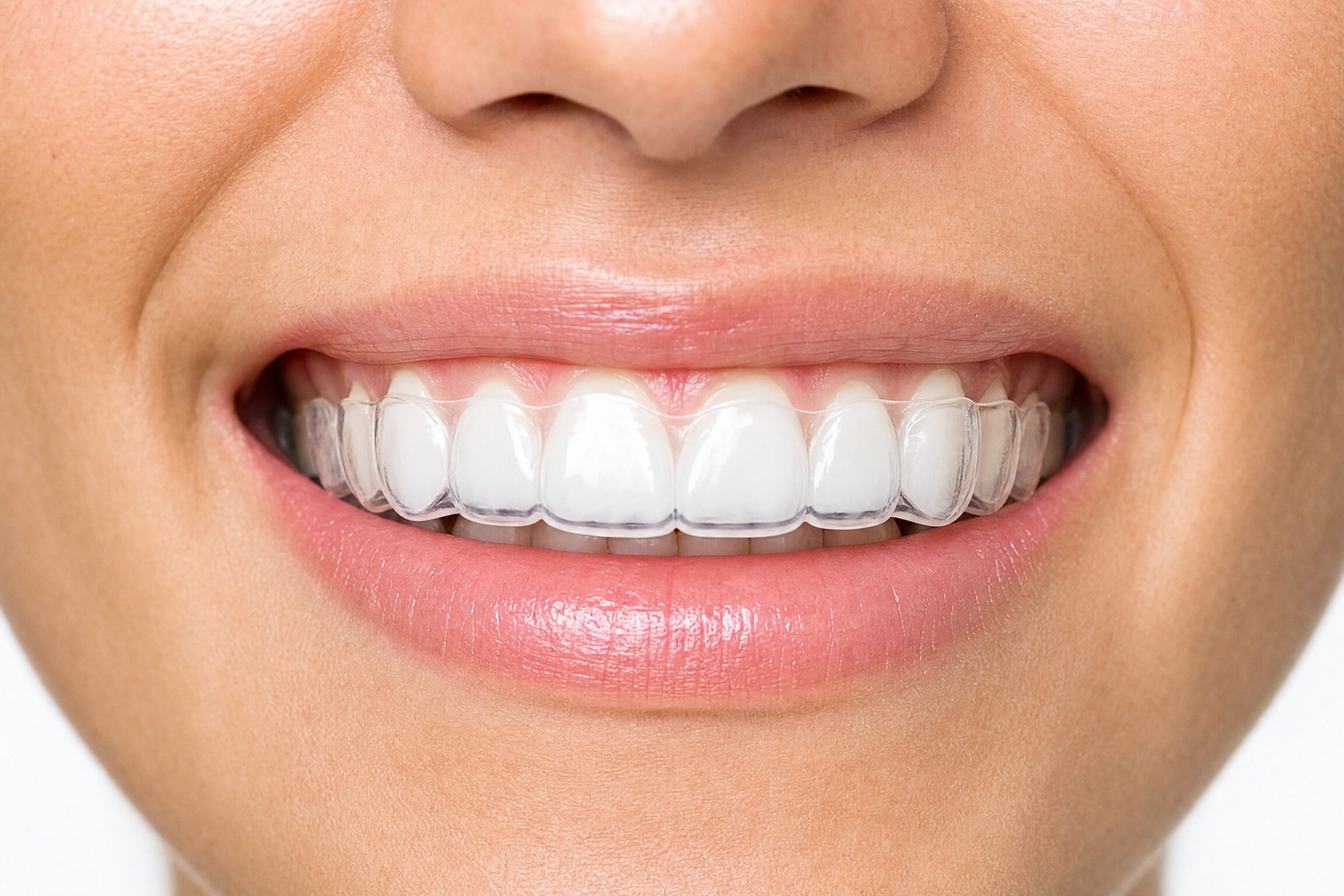 Close-up of a custom night guard fitting perfectly over teeth