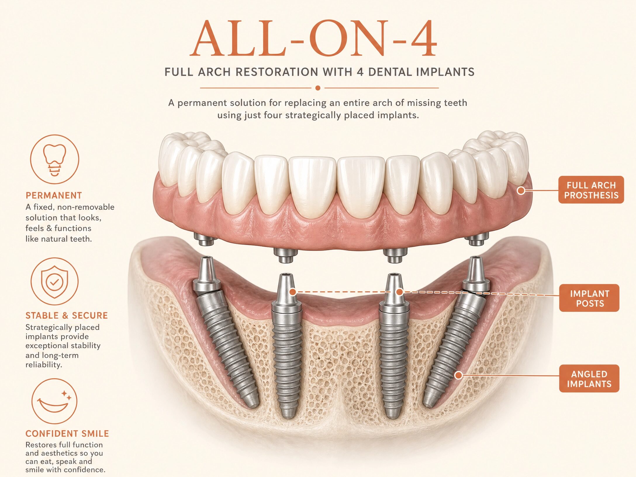 All-on-4 dental implant diagram showing 4 implants supporting a full arch bridge