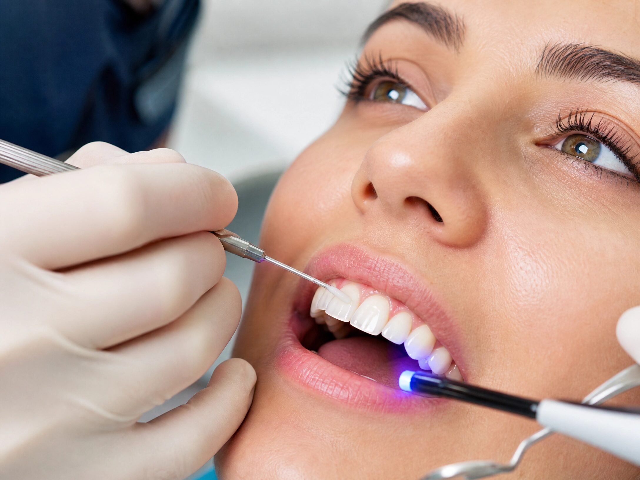 Dental Bonding