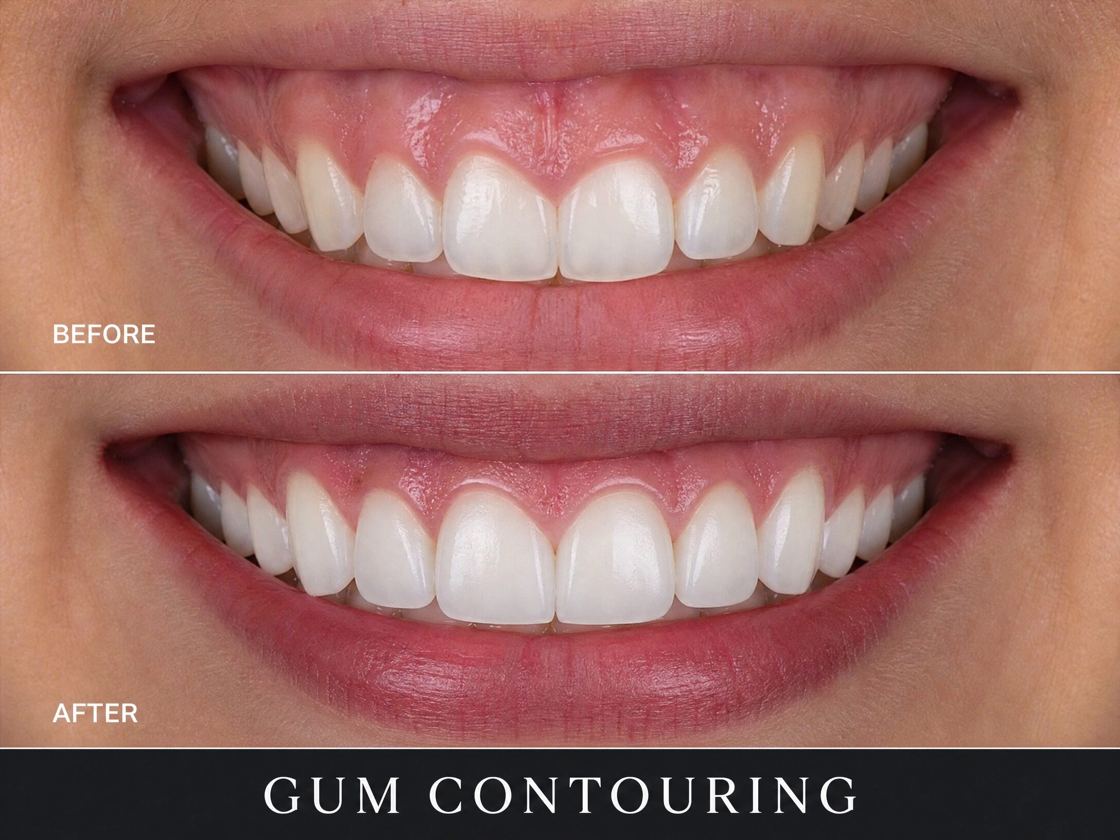 Gum Contouring