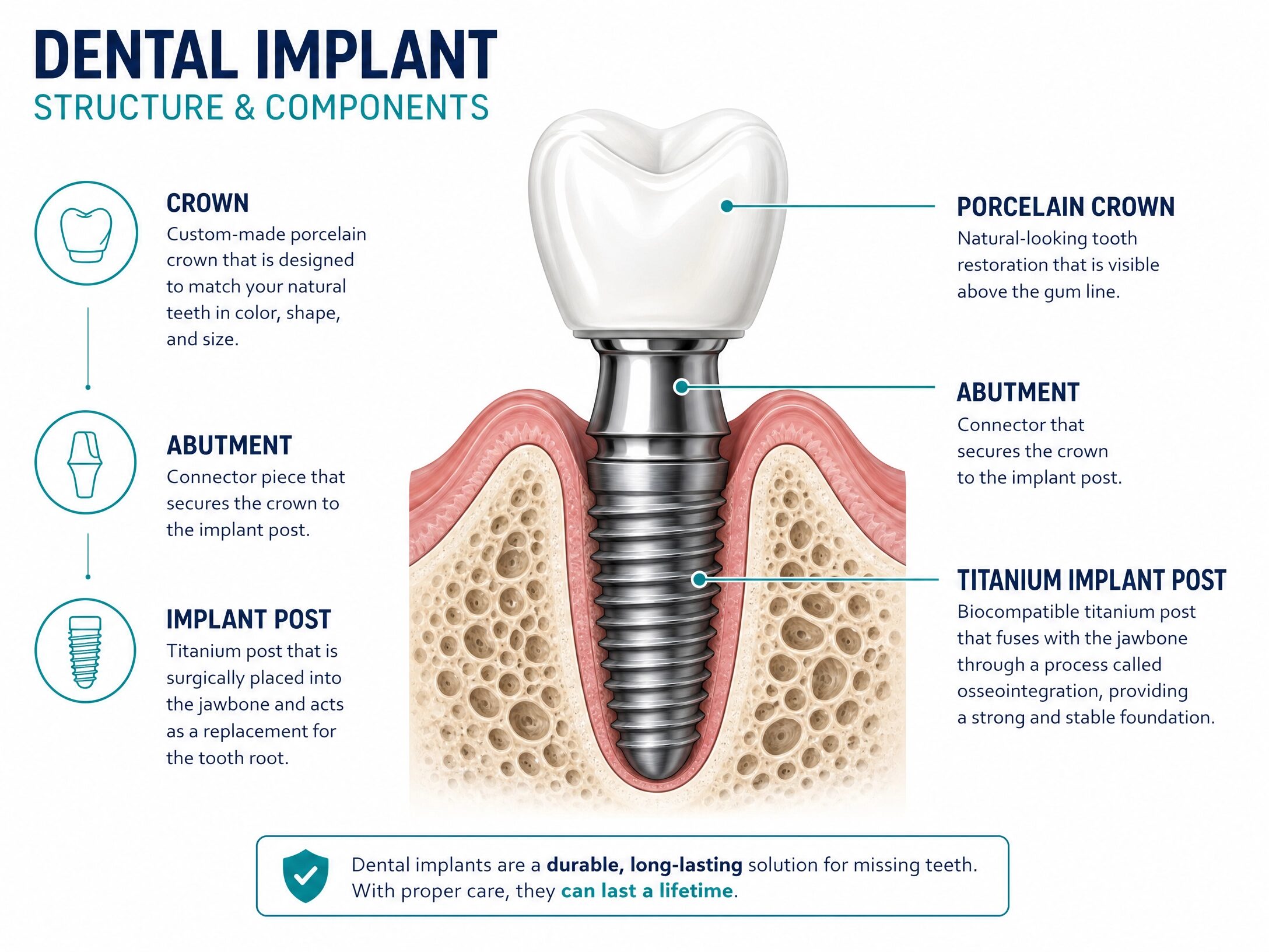 Dental implant structure diagram showing titanium post, abutment, and crown