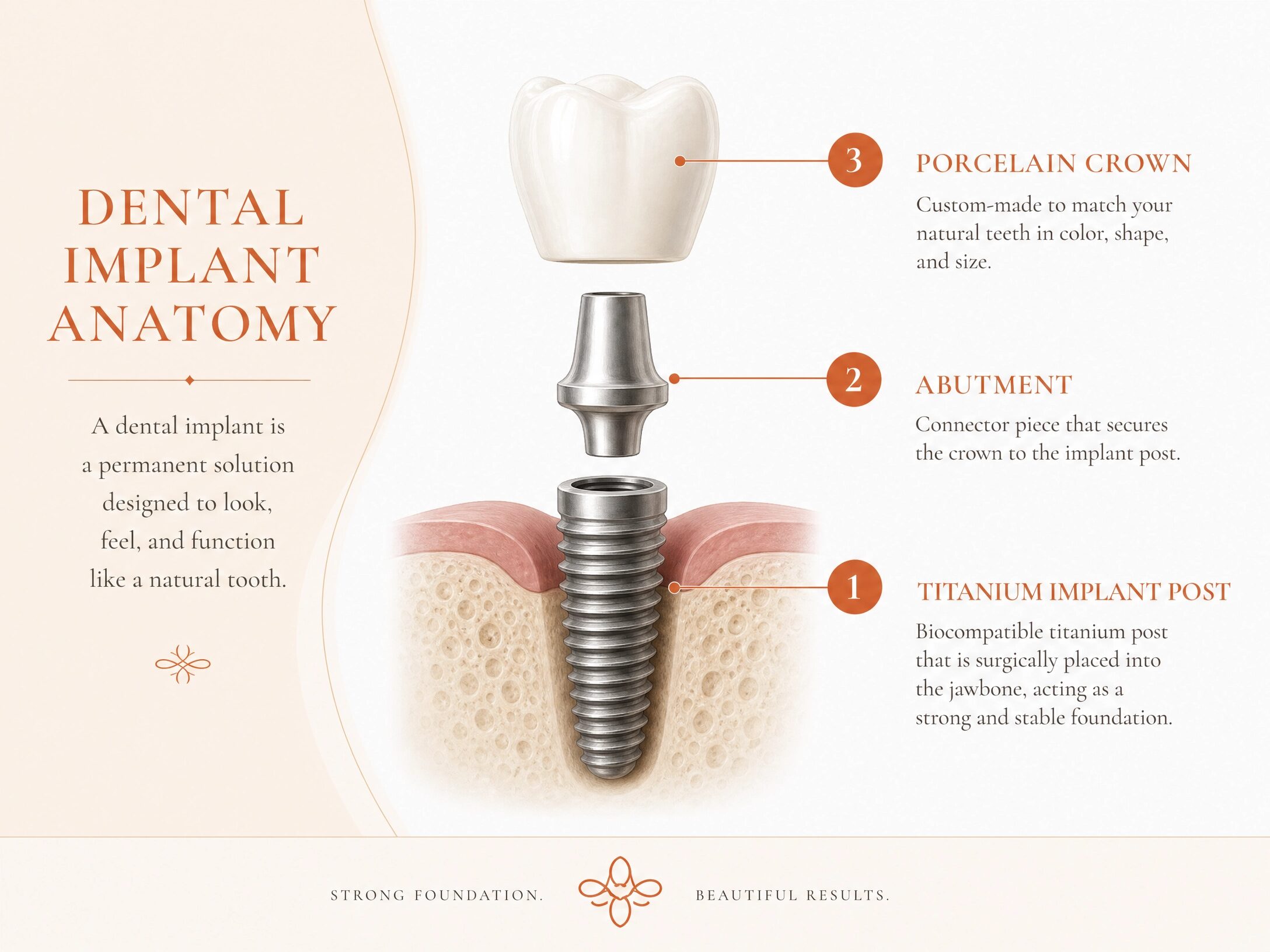 Dental implant anatomy diagram showing titanium post, abutment, and porcelain crown