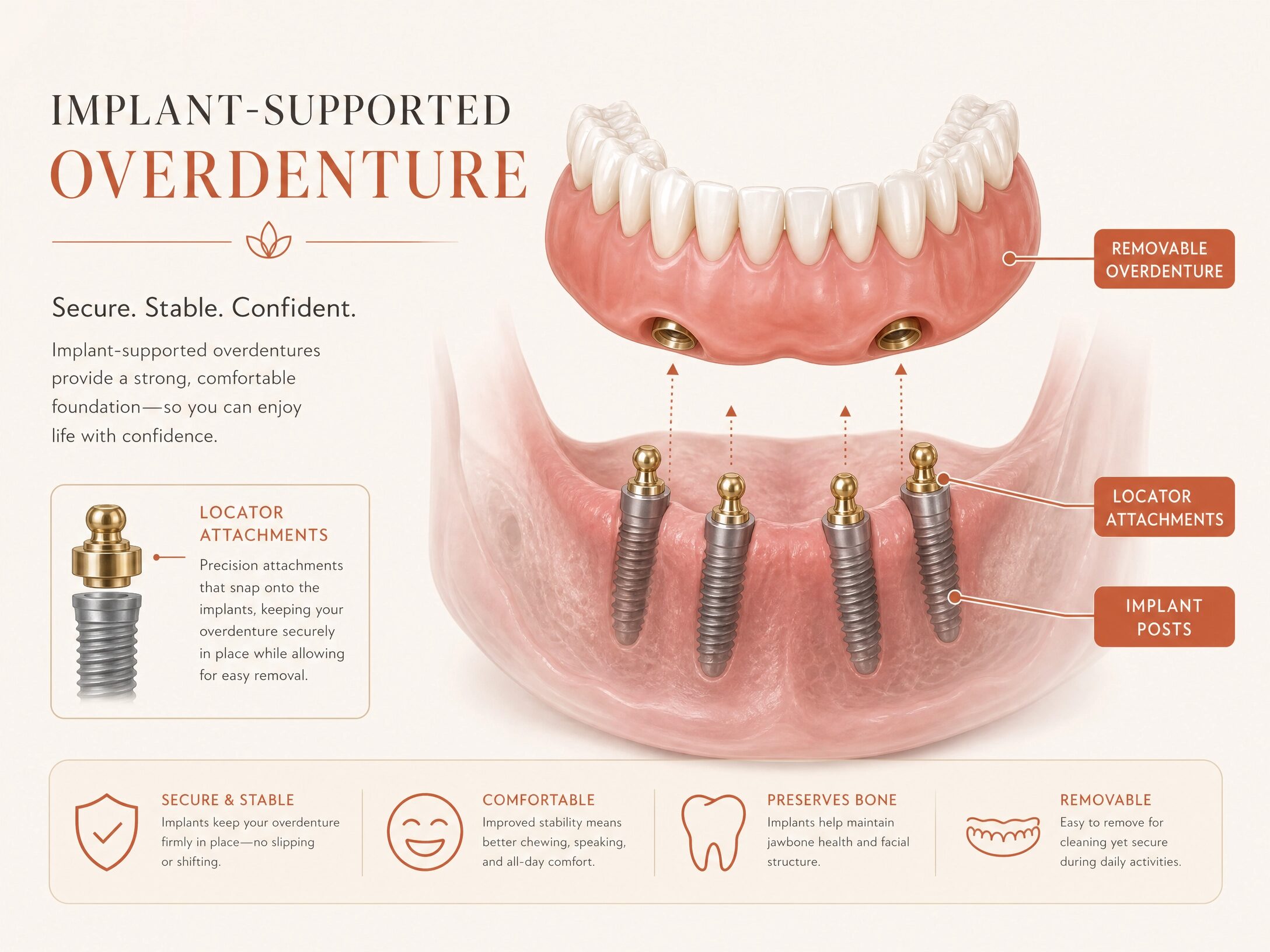 Implant-supported overdenture diagram showing implants and snap-on attachments