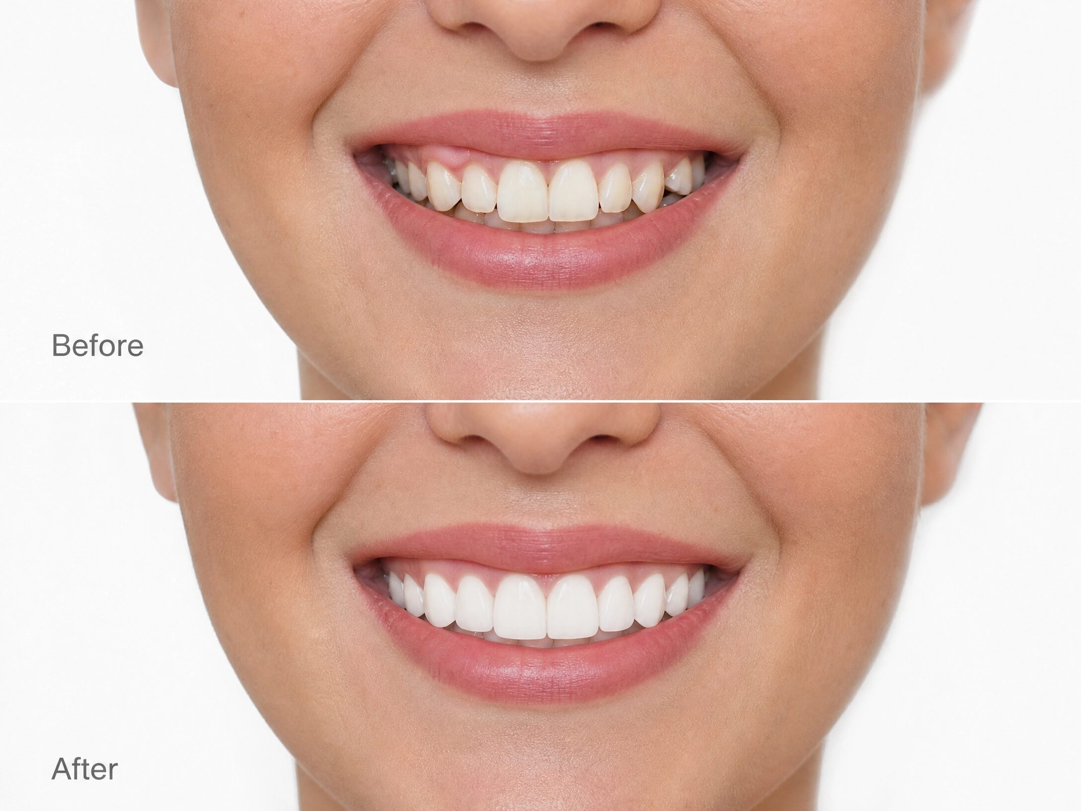 Porcelain Veneers
