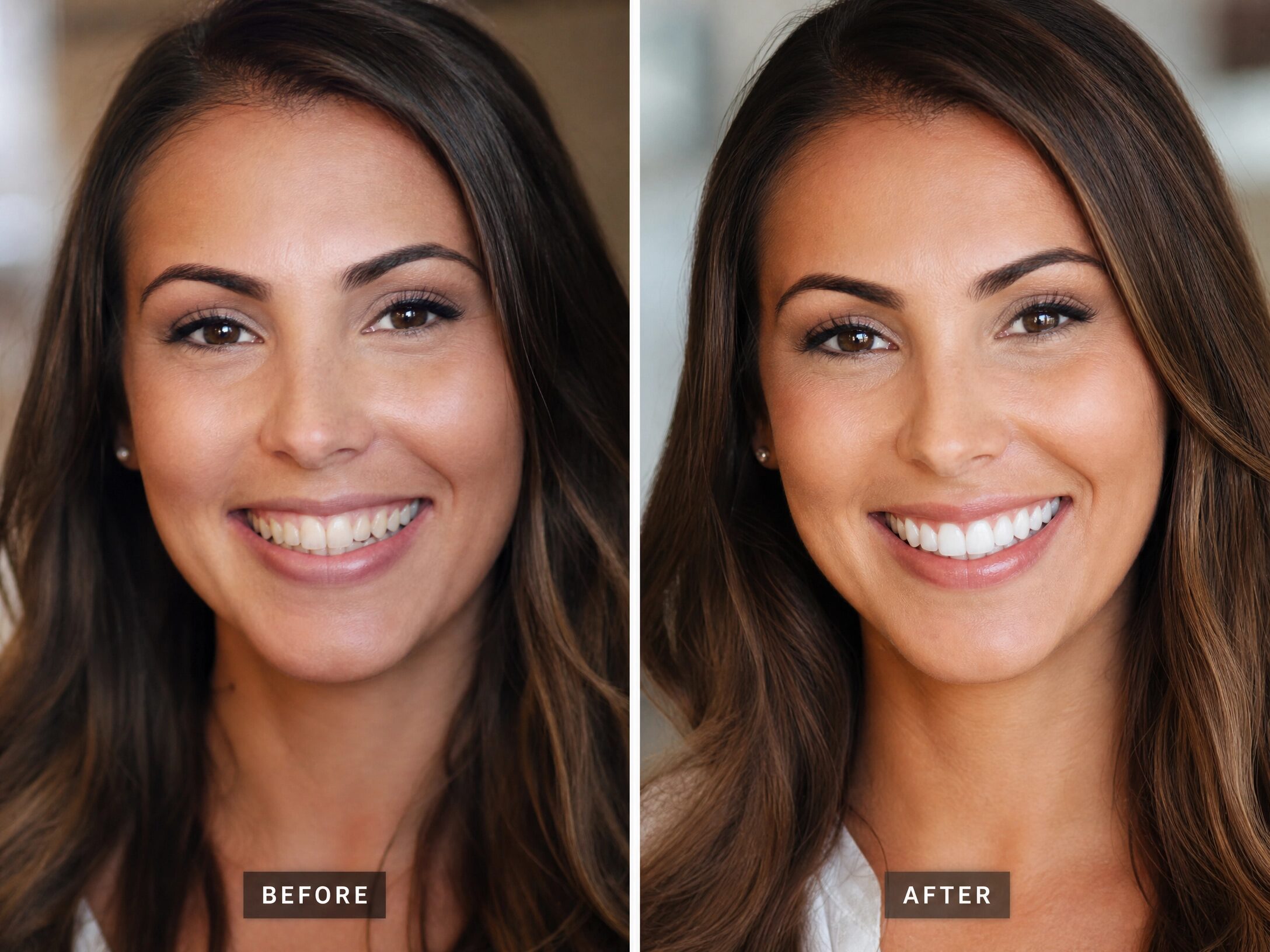 Smile Makeover