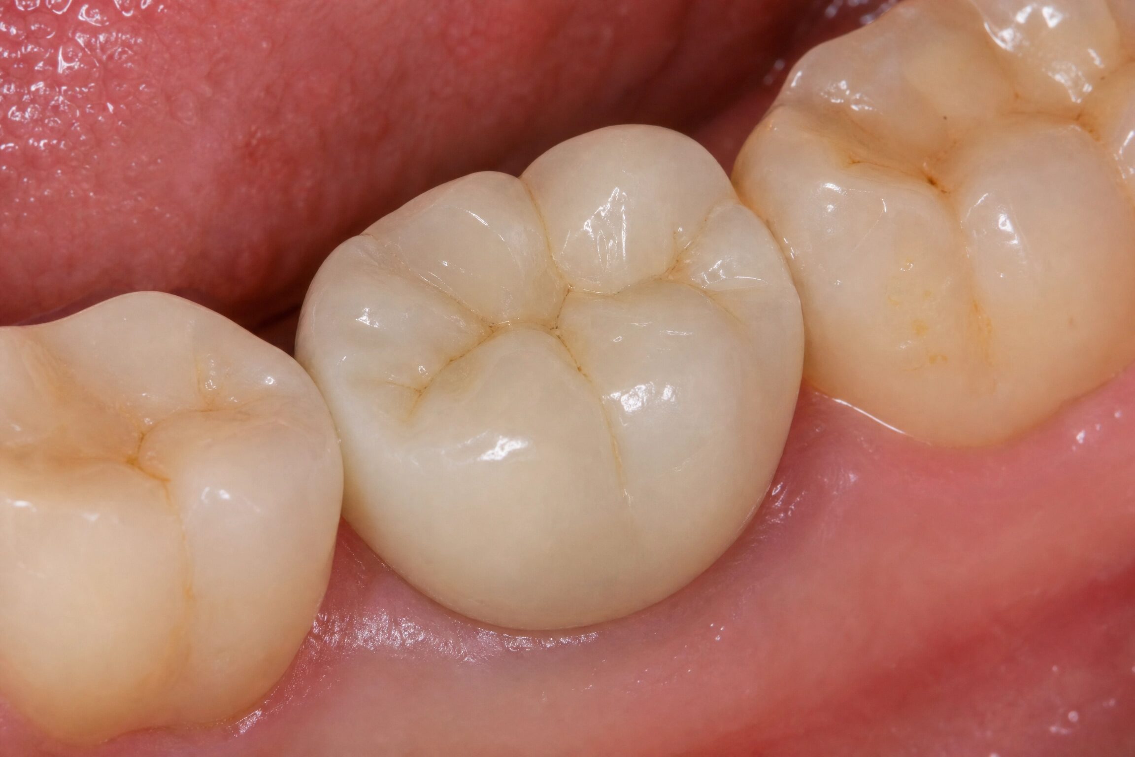 Zirconia dental crown for back molar